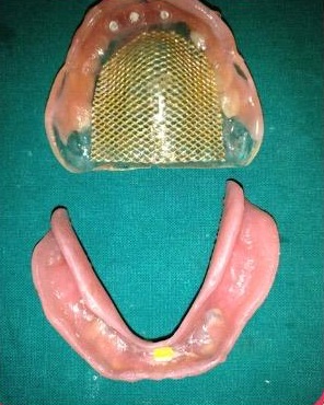 The upper and lower dentures, Complete Dentures at Smile 4U Family Dental Clinic, Kurla