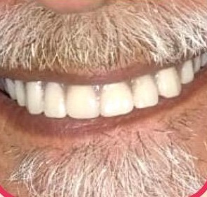 The finished smile, Complete Dentures at Smile 4U Family Dental Clinic, Kurla