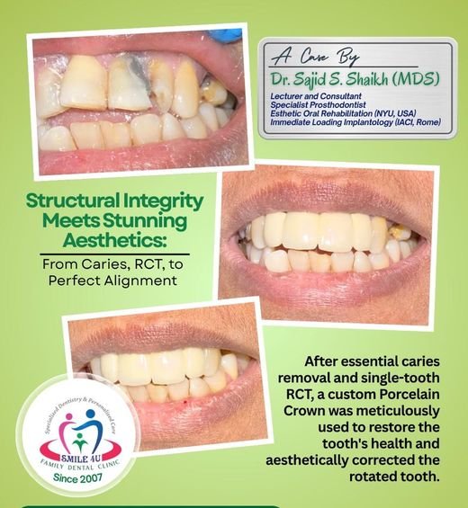 Structural Integrity Meets Stunning Aesthetics - dental case treated by Dr. Sajid S. Shaikh at Smile 4U, Kurla