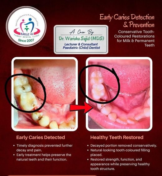 Early Caries Detection & Prevention - dental case treated by Dr. Warisha Shaikh at Smile 4U, Kurla