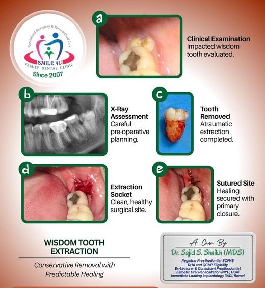 Wisdom Tooth Extraction, Conservative Removal - dental case treated by Dr. Sajid S. Shaikh at Smile 4U, Kurla