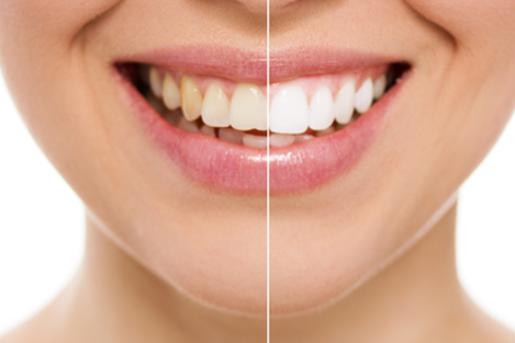 Teeth Cleaning at Smile 4U Family Dental Clinic, Kurla, Mumbai