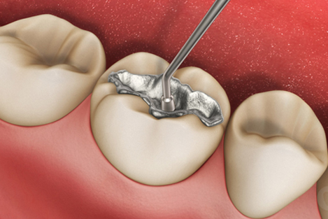 Filling And Restorations at Smile 4U Family Dental Clinic, Kurla, Mumbai
