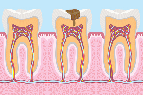 RCT (Root Canal Treatment) at Smile 4U Family Dental Clinic, Kurla, Mumbai