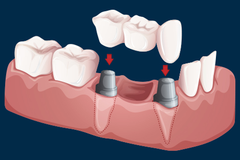 Fixed Teeth (Crowns and Bridges) at Smile 4U Family Dental Clinic, Kurla, Mumbai