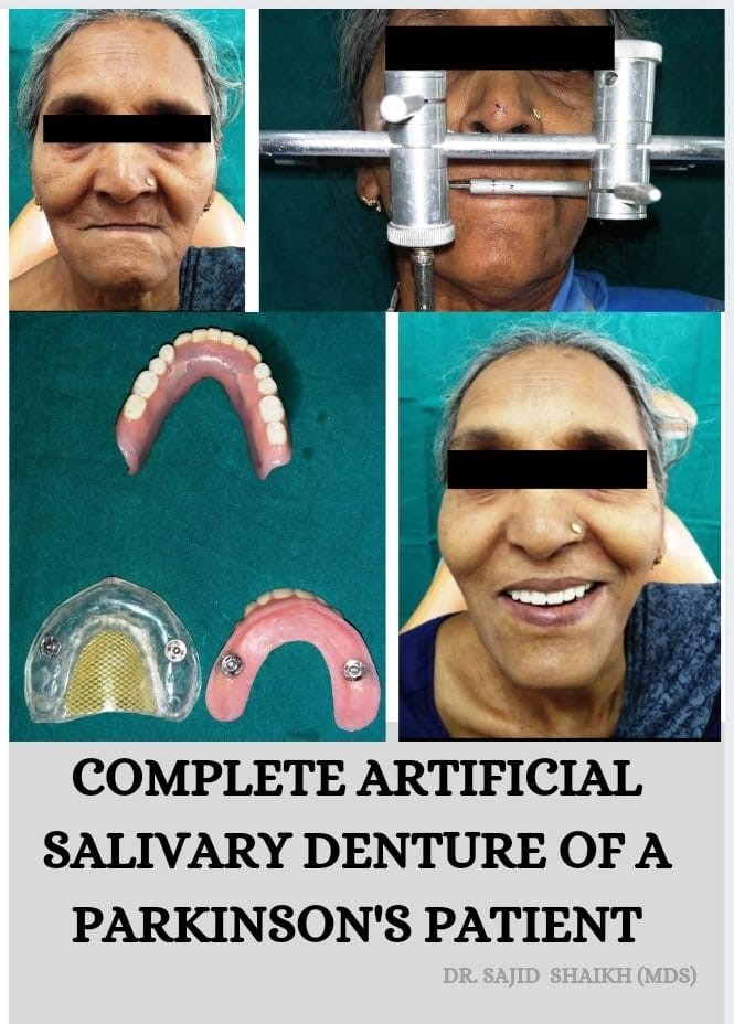 Removable Teeth at Smile 4U Family Dental Clinic, Kurla, Mumbai
