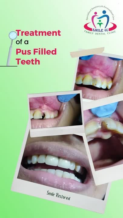 Treatment of a Pus-Filled Tooth - treatment video at Smile 4U Family Dental Clinic, Kurla