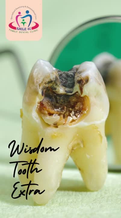 Wisdom Tooth Extraction, Severely Decayed Tooth - treatment video at Smile 4U Family Dental Clinic, Kurla