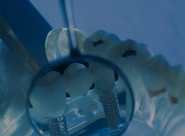 For my Implant supported teeth/denture how many Implants do I need?
