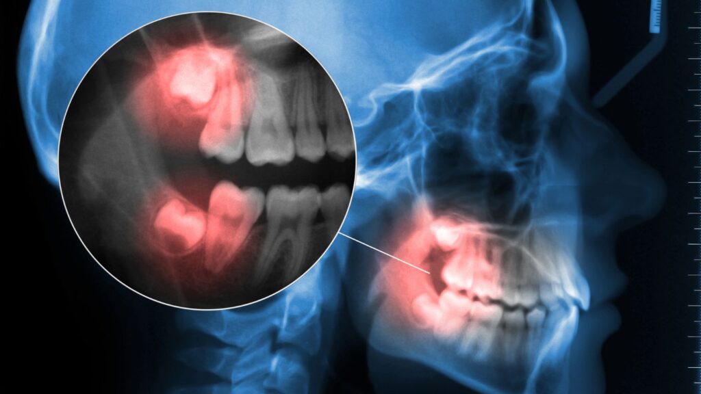 Wisdom Tooth: Everything You Need to Know.