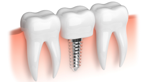 Why Are Dental Implants the Best Solution for Missing Teeth?