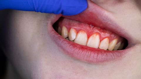 Gum Disease: Understanding, Preventing, and Treating